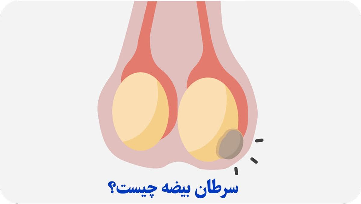 بهبود سرطان بیضه