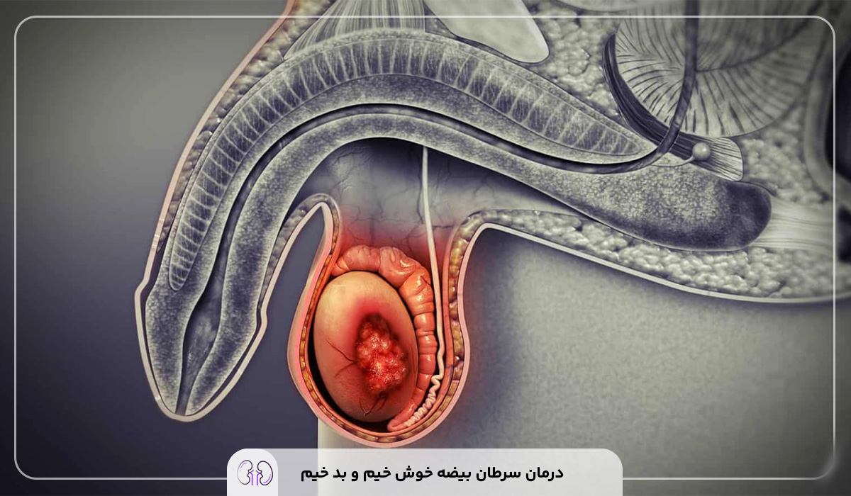 علائم سرطان بیضه
