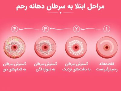 سرطان رحم