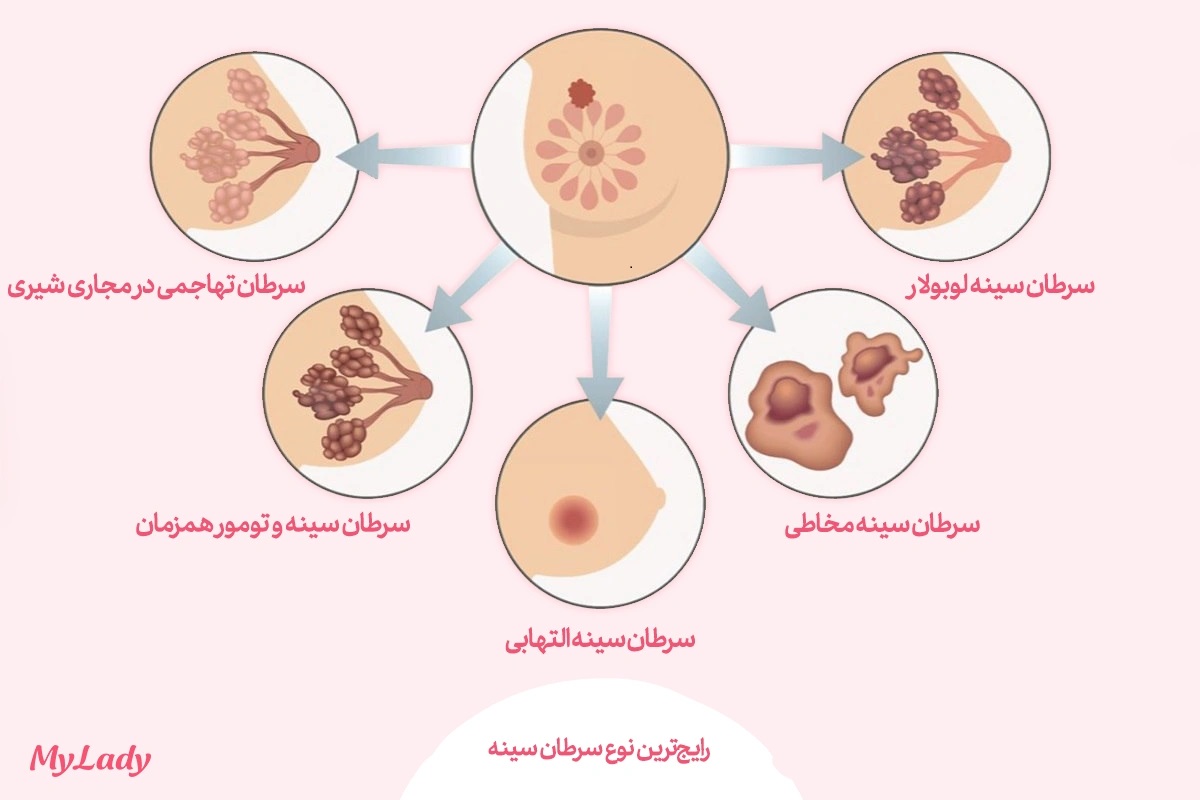 علائم سرطان سینه