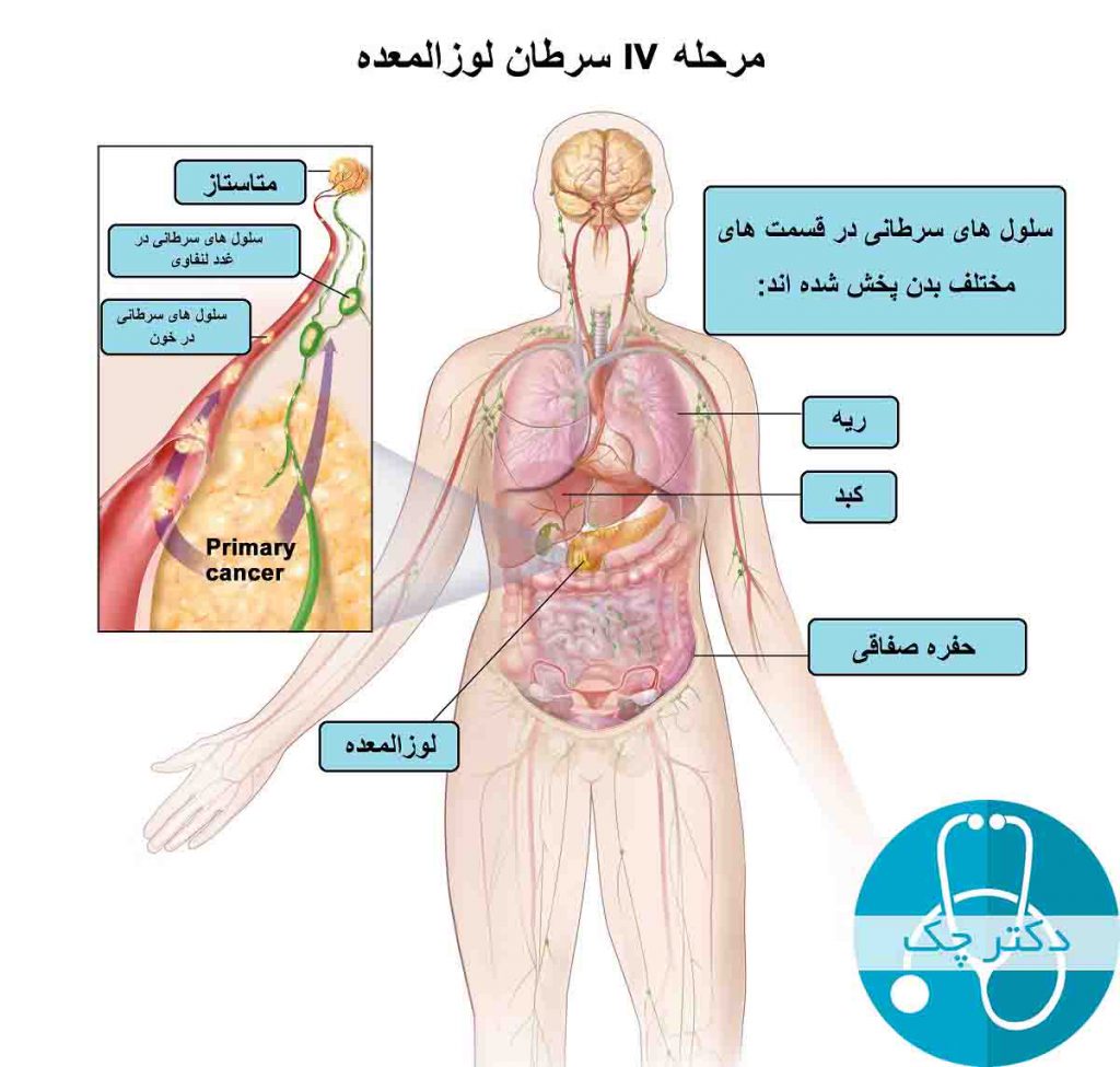 علائم سرطان لوزالمعده