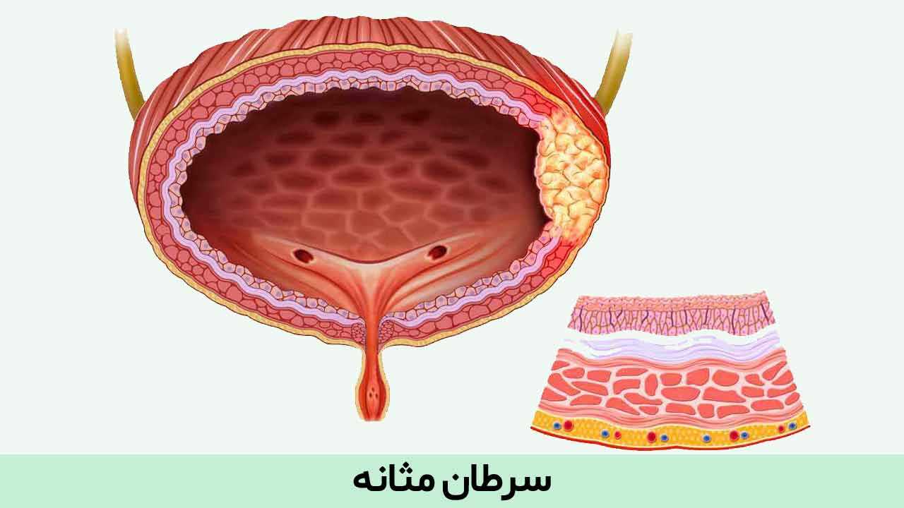 عوامل سرطان مثانه