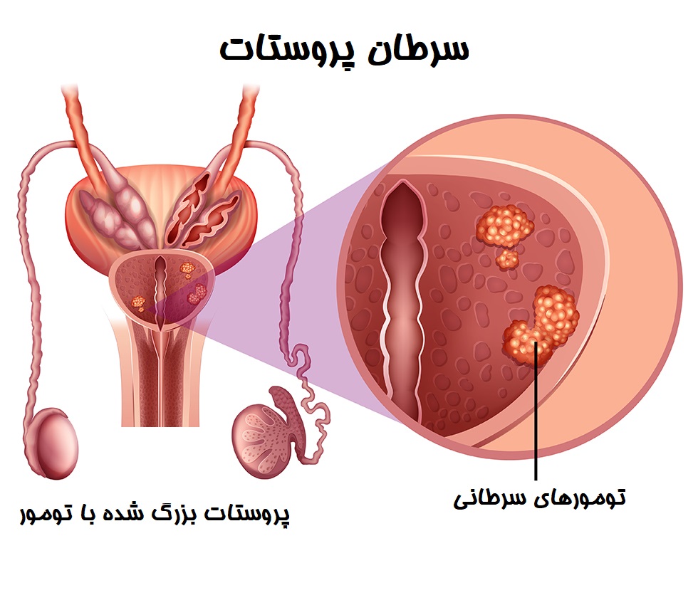 علائم سرطان پروستات
