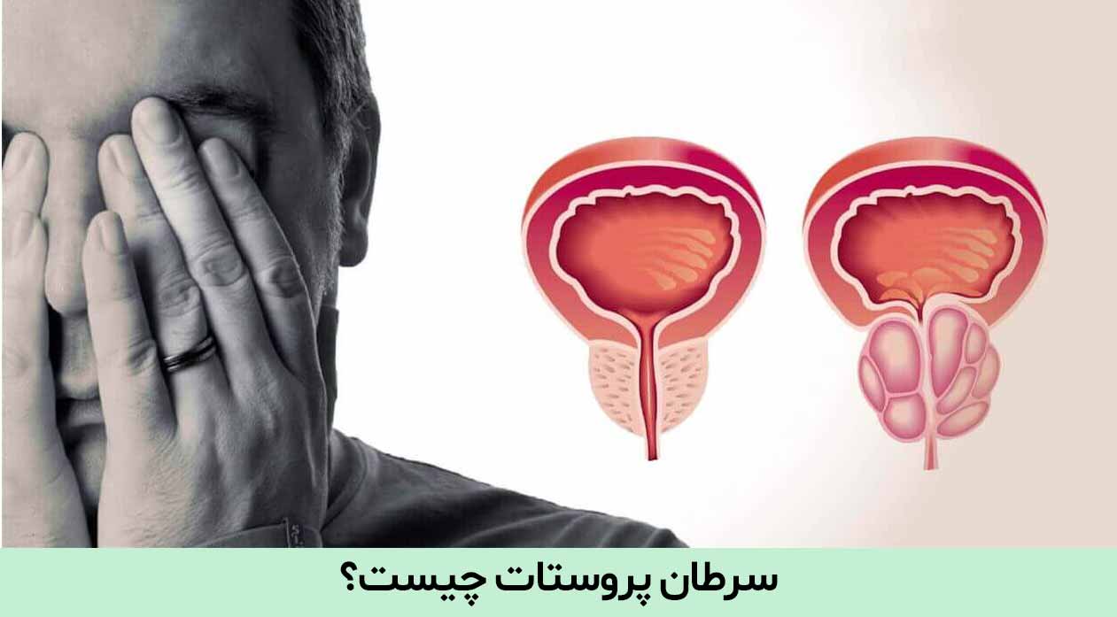 مراحل سرطان پرسوتات