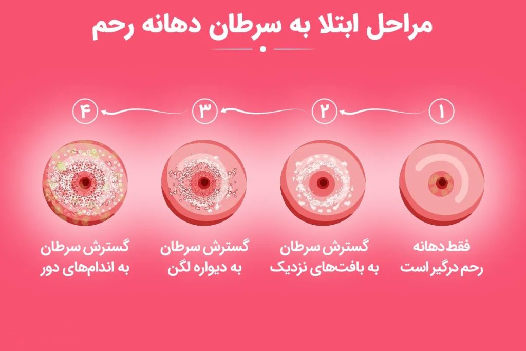 سرطان رحم